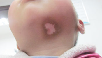 小孩脸颊部位白斑初期适合哪种方法治疗”